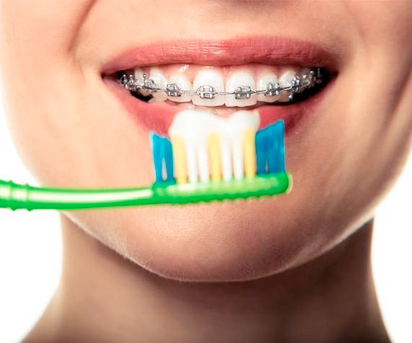 cepillarse los dientes con brackets
