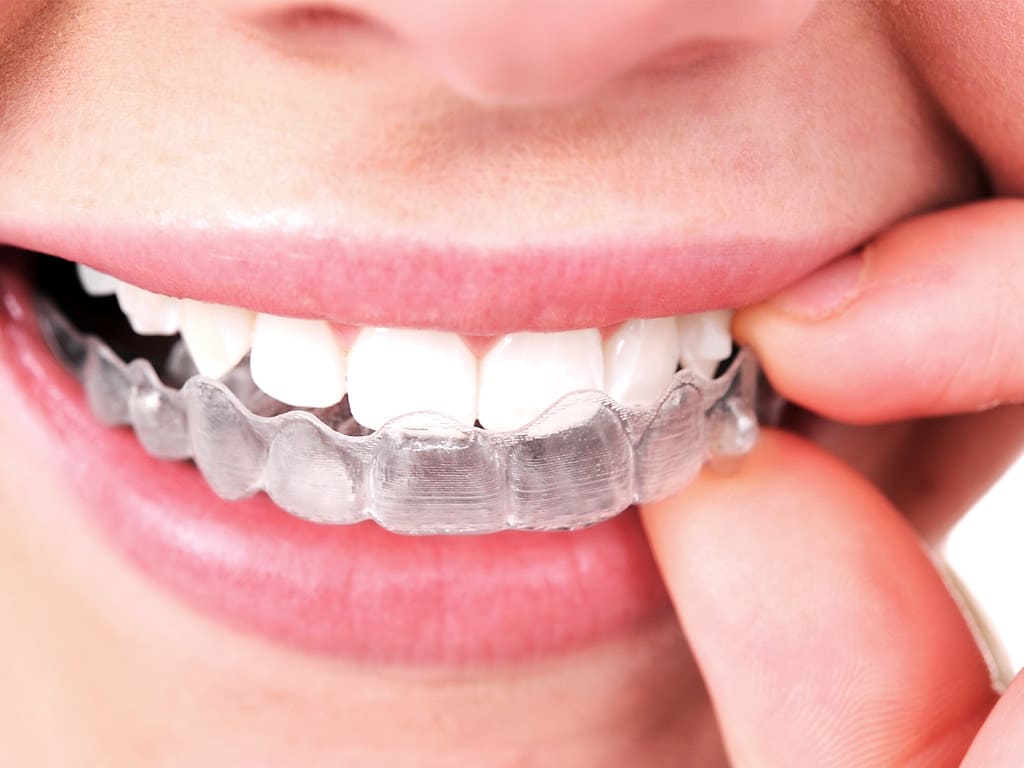 sonrisa de una mujer con invisalign